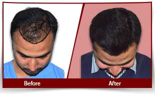 Hair Transplant results in India