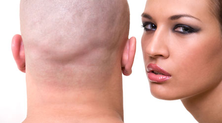 Stress and Hair Loss