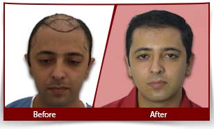 hair transplant before and after