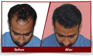 Hair Transplant results in India