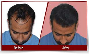 hair transplant before and after