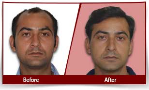 hair transplant before and after