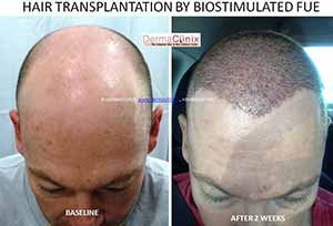 Hair Transplant results in India