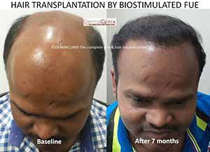 Hair Transplant results in India