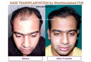 Hair Transplant results in India