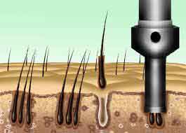 FUE hair transplant method