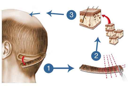 FUT hair transplant method FUT hair transplant method