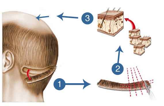 FUT hair transplant method 