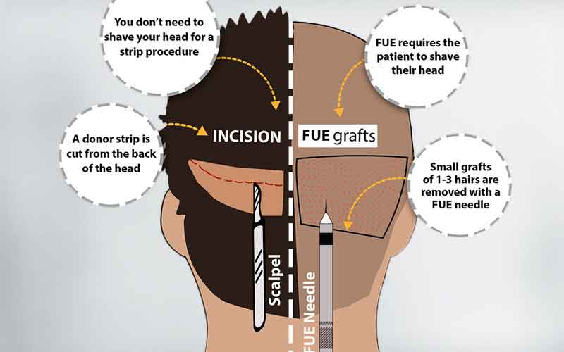 FUE VS FUT hair transplant comparison