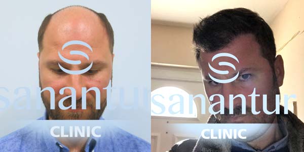 hair transplant before and after